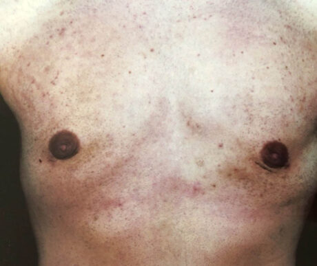 Gynecomastia case #119672