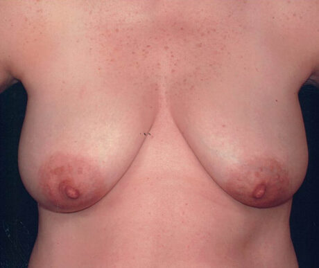 Breast Reduction case #119684