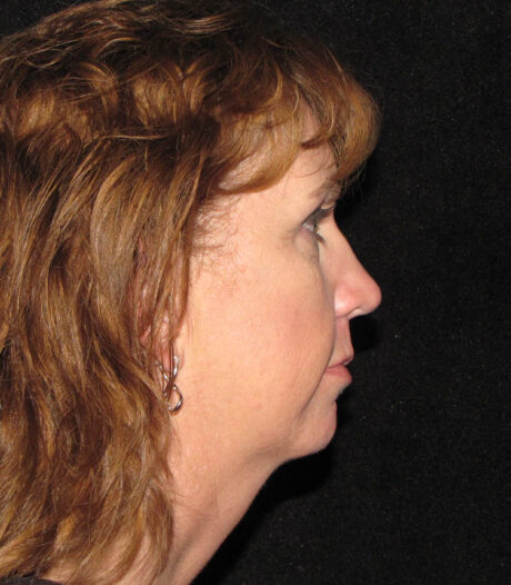 Chin Augmentation case #119790