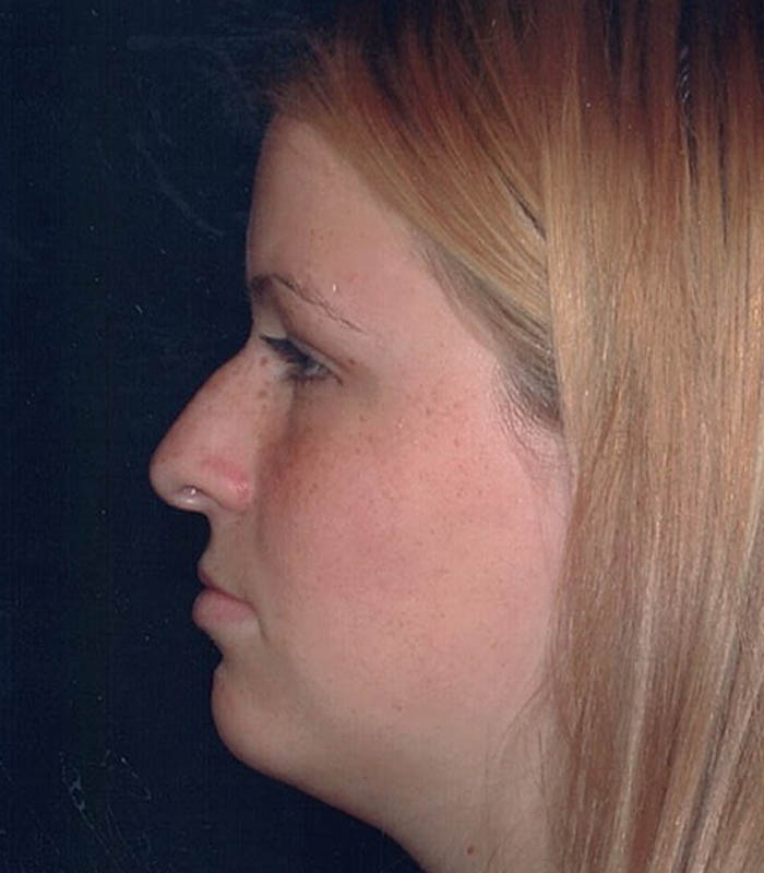 Rhinoplasty case #119770