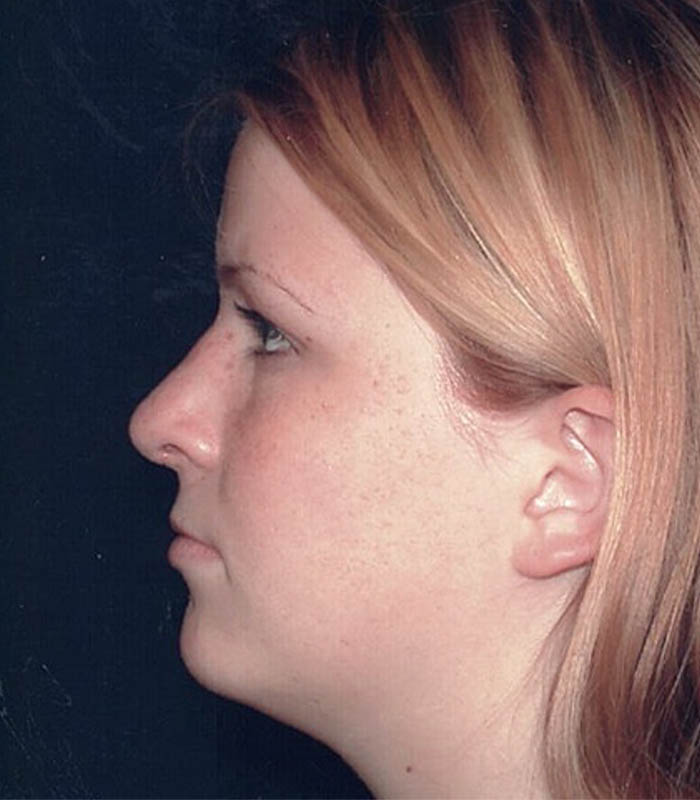 Rhinoplasty case #119770