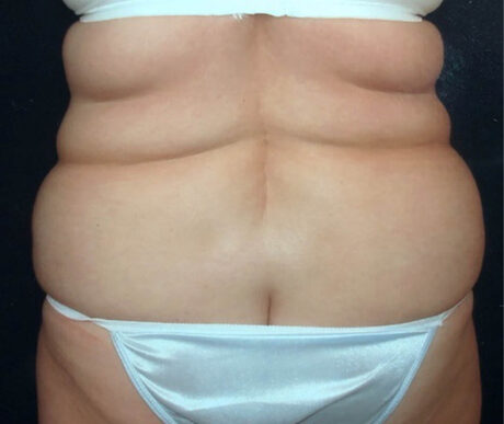 Liposuction case #119658