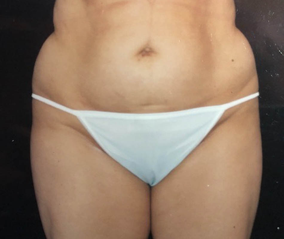 Liposuction case #119658