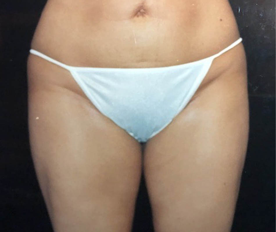 Liposuction case #119658