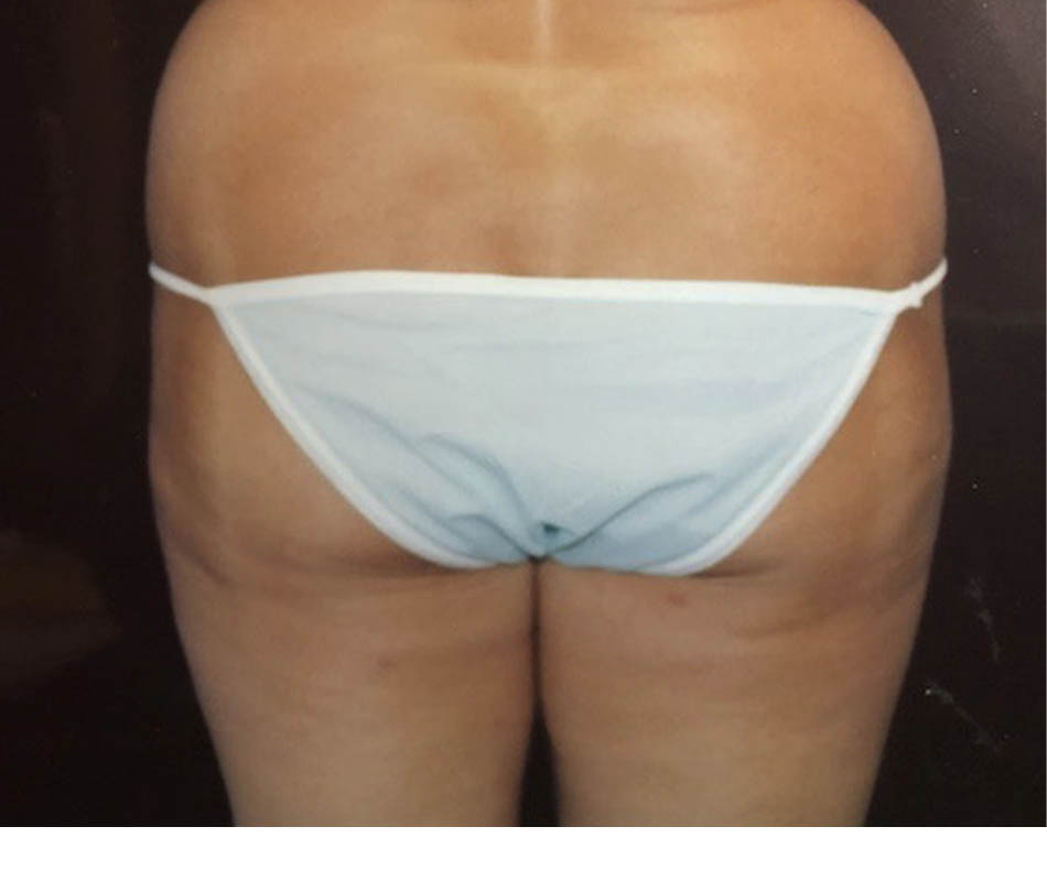 Liposuction case #119658