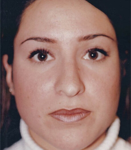 Rhinoplasty case #119765