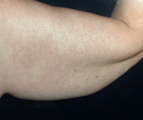 Liposuction case #119636