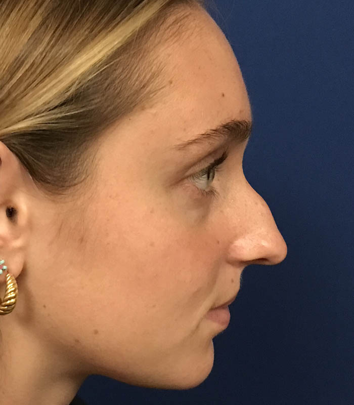 Rhinoplasty case #119778