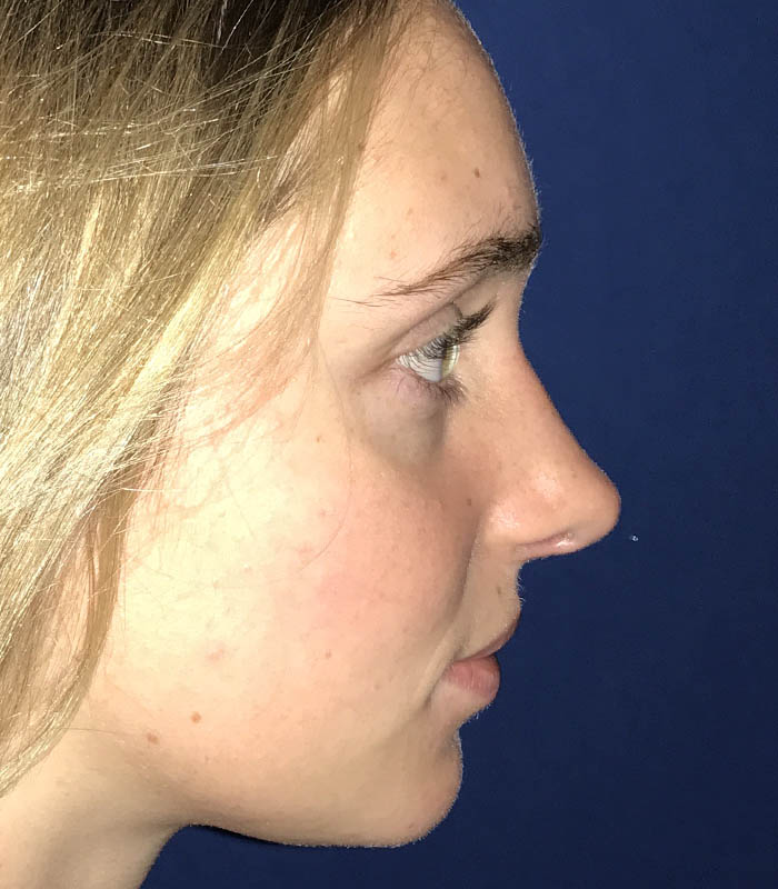 Rhinoplasty case #119778