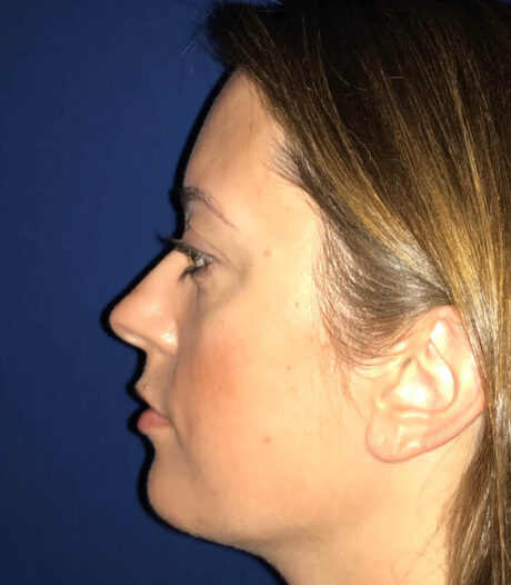 Chin Augmentation case #119757