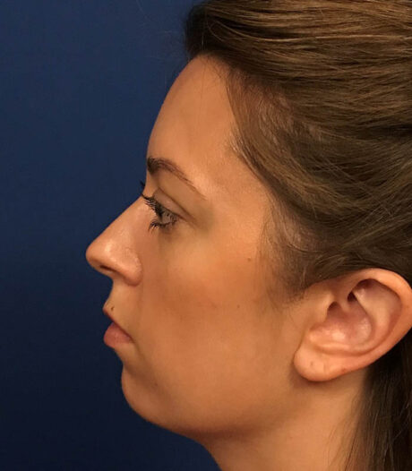 Chin Augmentation case #119757