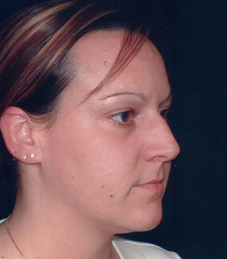 Rhinoplasty case #119773