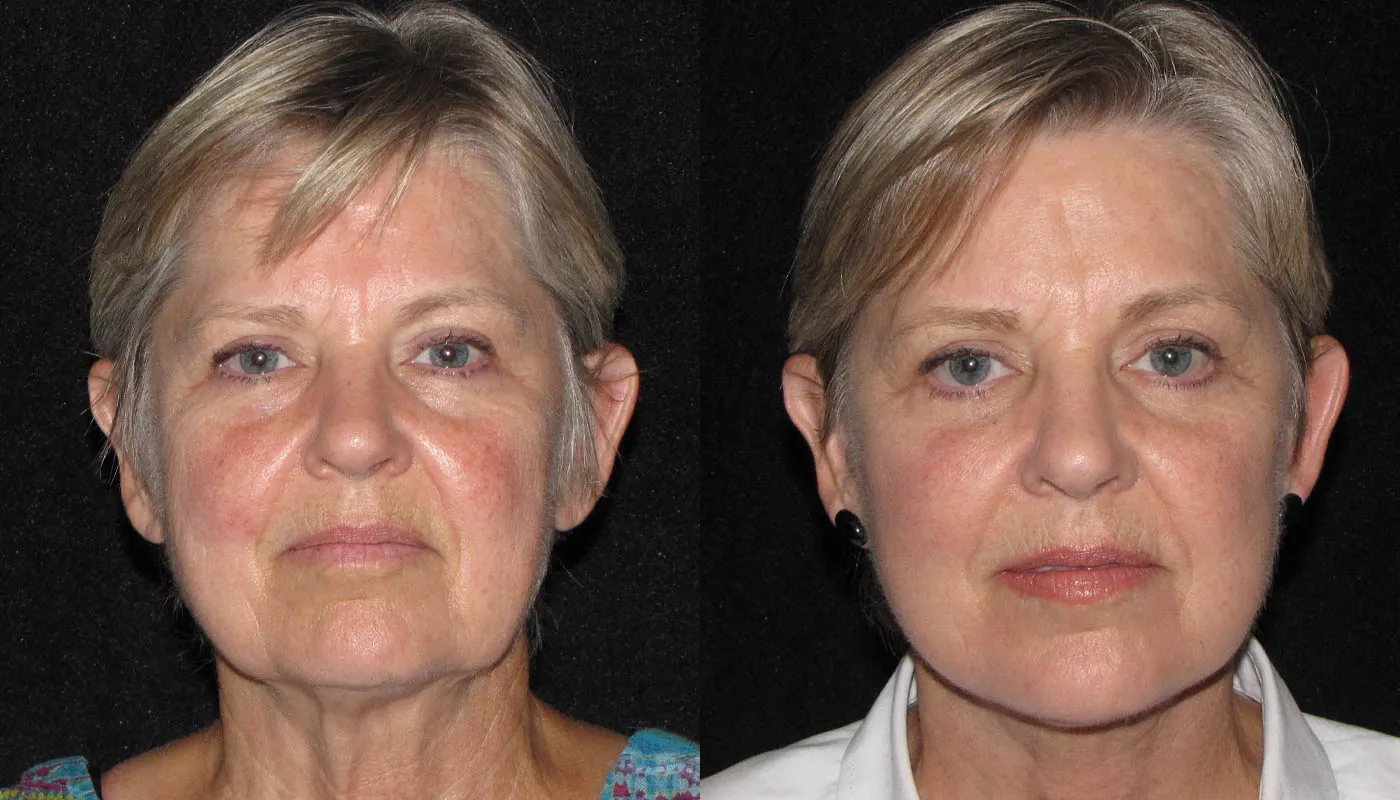 facelift-spotlight-ba